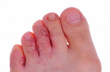 Athlete's foot dictionary definition | athlete's foot defined Athlete's foot dictionary definition | athlete's foot defined