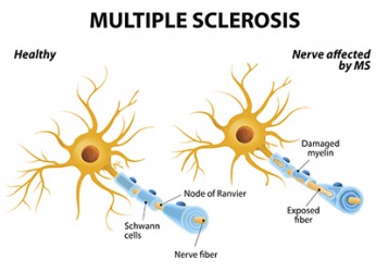 Sclerosis dictionary definition | sclerosis defined