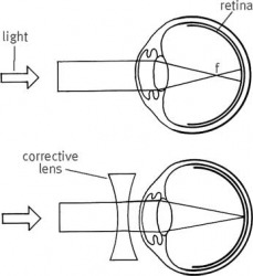 Myopia dictionary definition | myopia defined